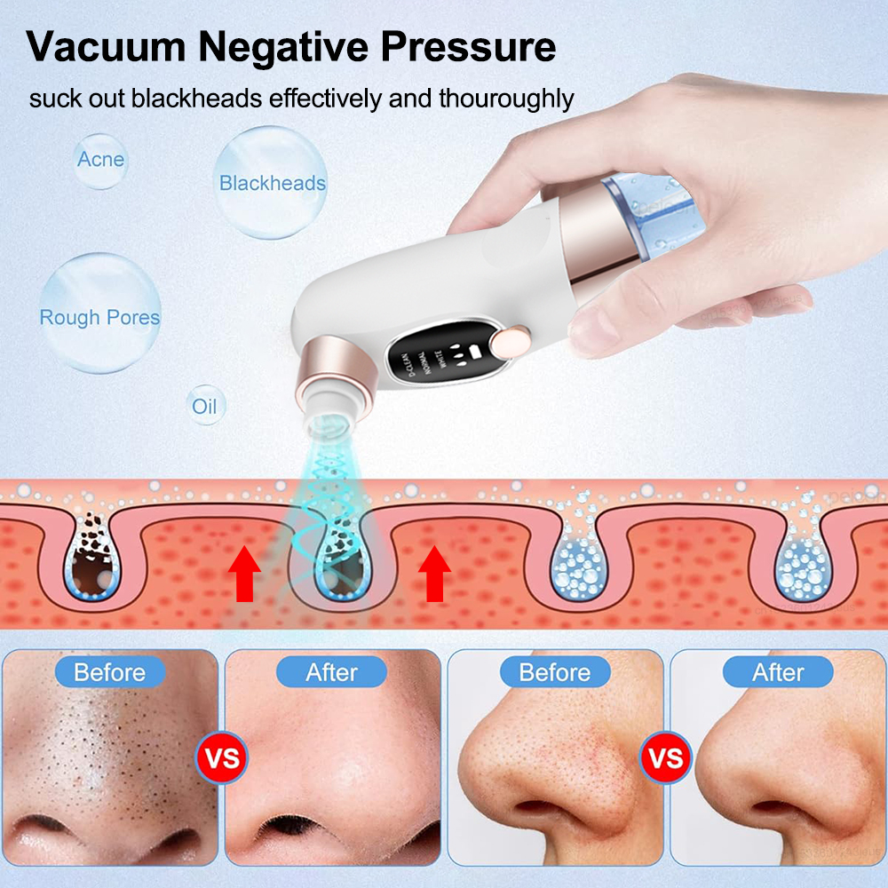 Blackhead Remover Electric Bla - Pore Vacuum recensione e prezzo