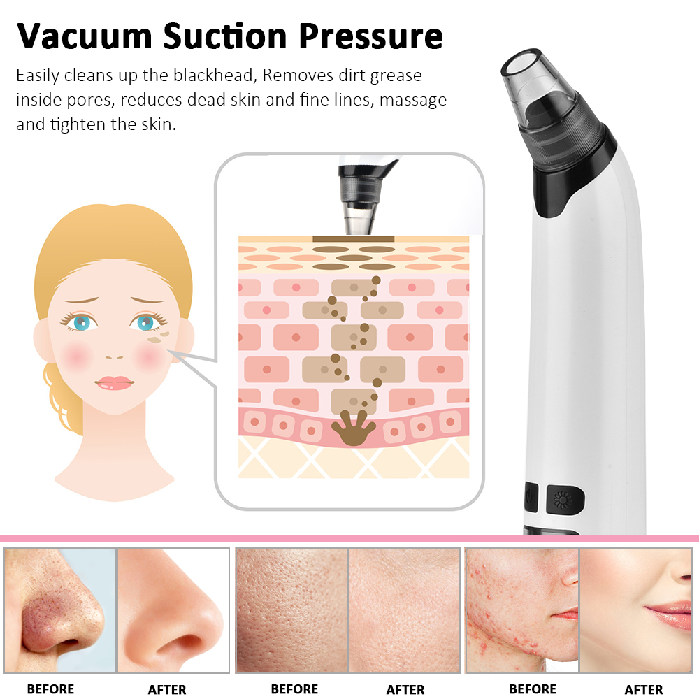 Blackhead Remover Electric Fac - Pore Vacuum recensione e prezzo