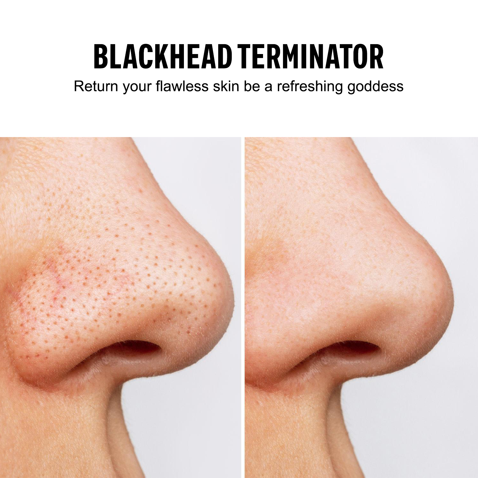 Blackhead Remover Vacuum Sucti - Pore Vacuum recensione e prezzo
