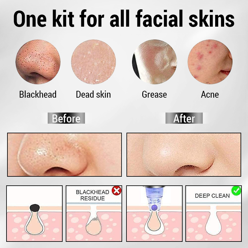 3 IN 1 Suction Blackheads God  - Pore Vacuum recensione e prezzo
