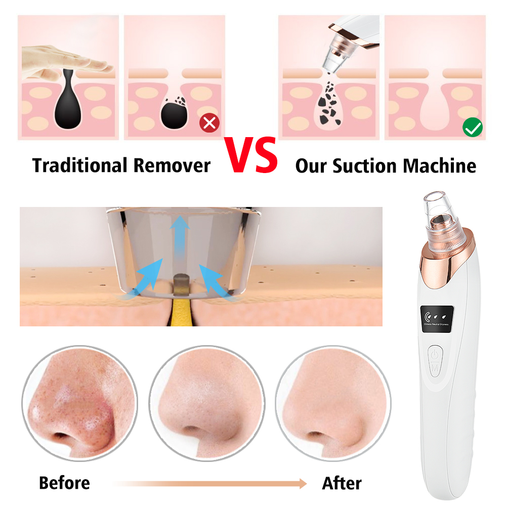 Blackhead Remover Vacuum Pore  - Pore Vacuum recensione e prezzo